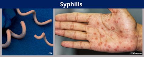 Syphilis